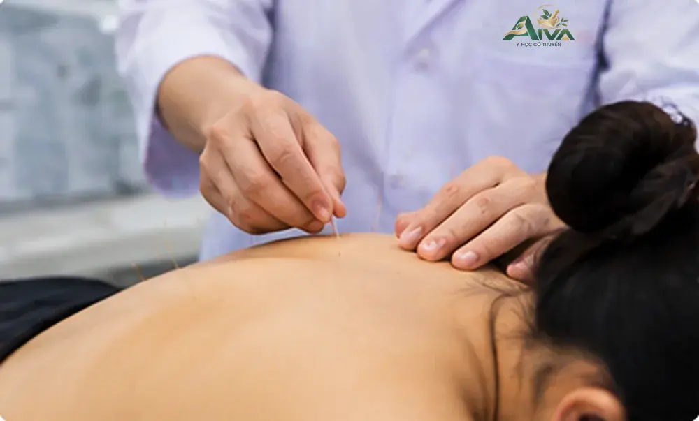 Châm cứu và bấm huyệt: những điều cần biết trước khi điều trị