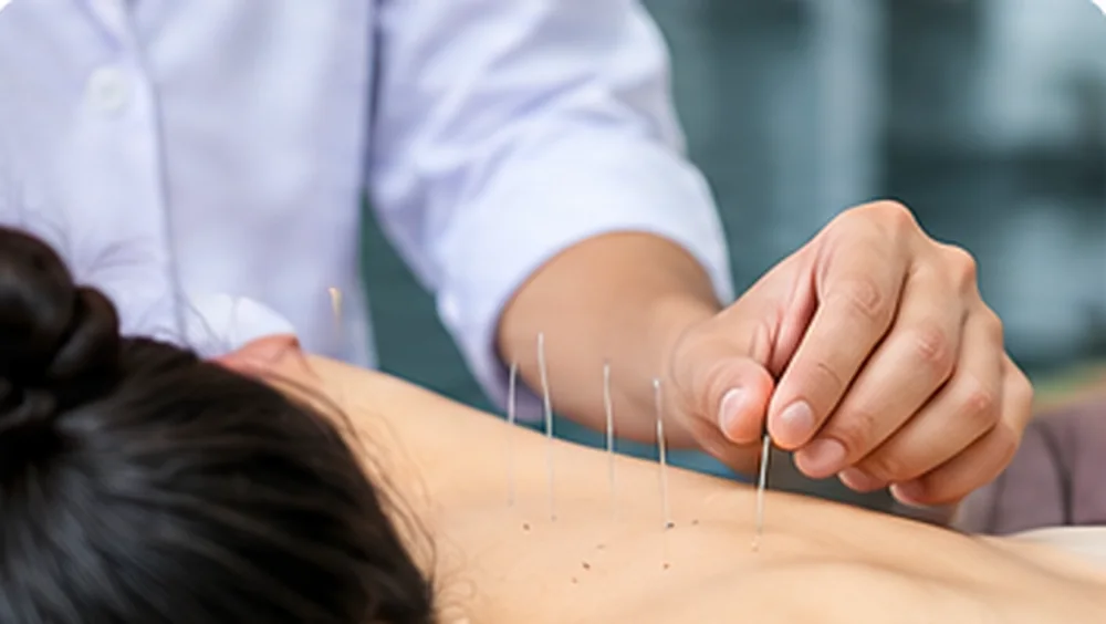 Châm cứu vùng lưng hỗ trợ giảm đau